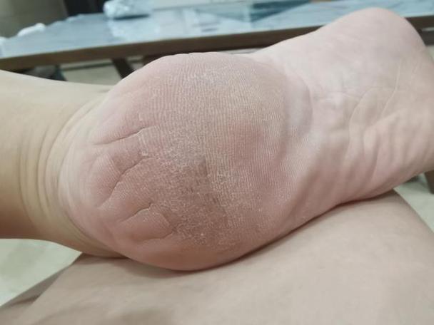 一只脚底发麻