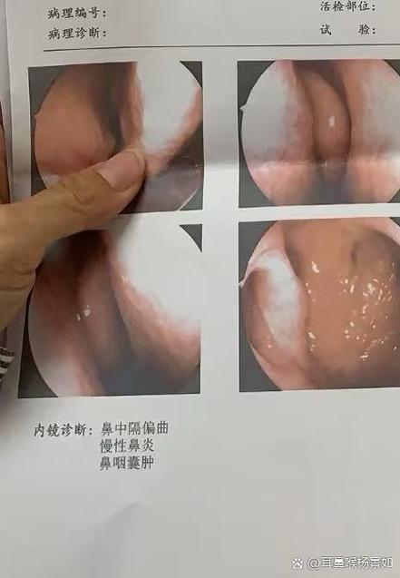 老流鼻血是怎么回事缩略图