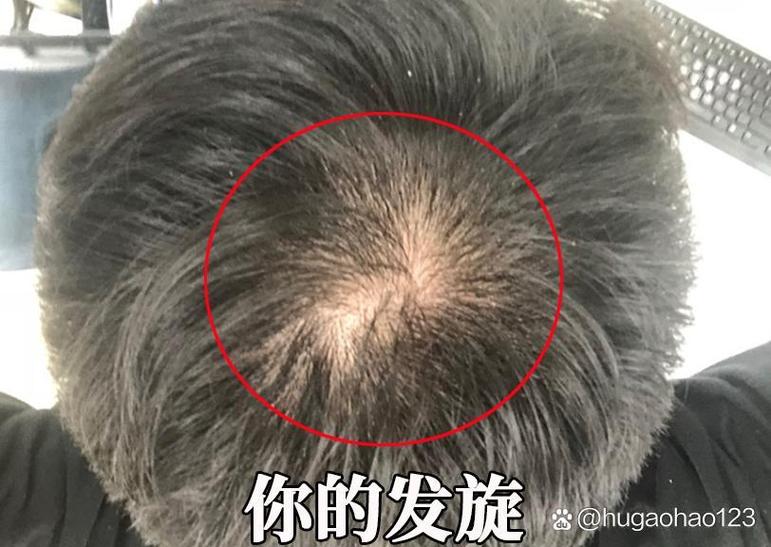 发旋处脱发能长出来吗