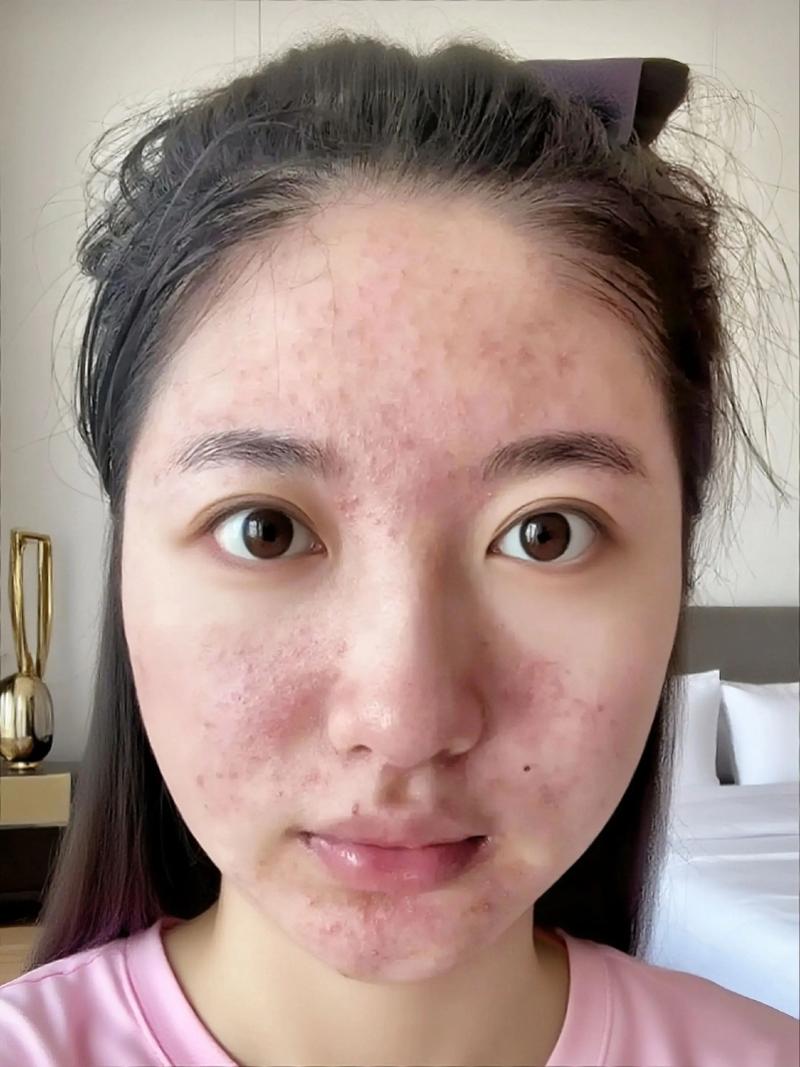 女孩说脸上长痘痘了幽默回复