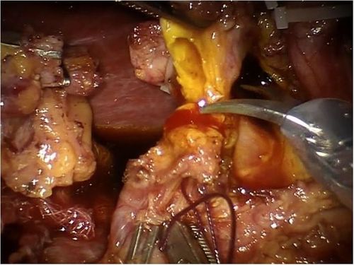 pancreaticoduodenectomy