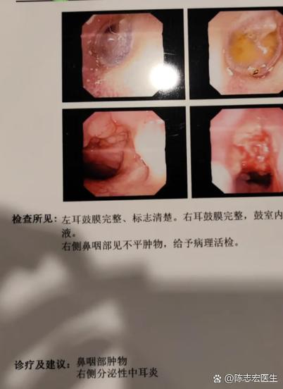 流鼻血只有一个鼻孔流怎么回事