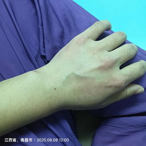 蓝血中毒