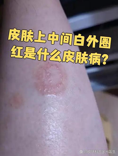 皮肤中间白色,周围红圈是什么病