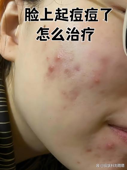 脸上长痘痘怎么消除有效方法