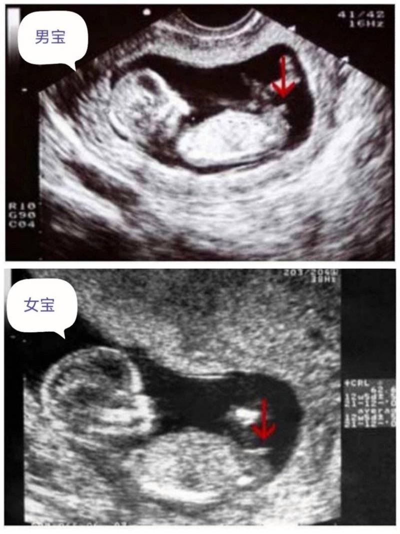 胎儿b超AFD是啥