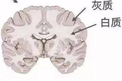 脑白质病变严重吗