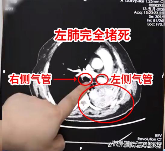 八十岁老人肺上有肿瘤怎么办