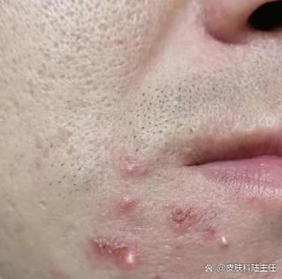 嘴角长痘缩略图