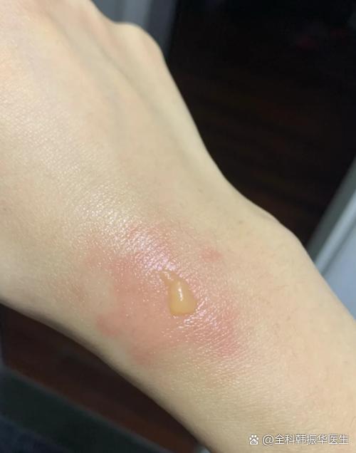 修复烫伤疤痕最好的方法