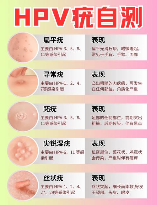 女性hpv病毒早期症状