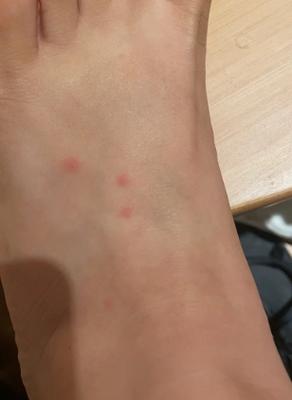 100只蚂蚁爬脚心痒吗
