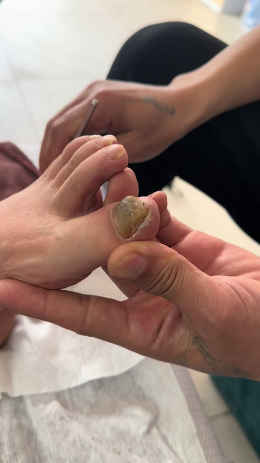 修脚店把我脚修发炎了
