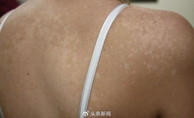 手脚白斑是什么原因引起的图标