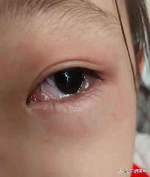 小孩子眼睛突然流眼水