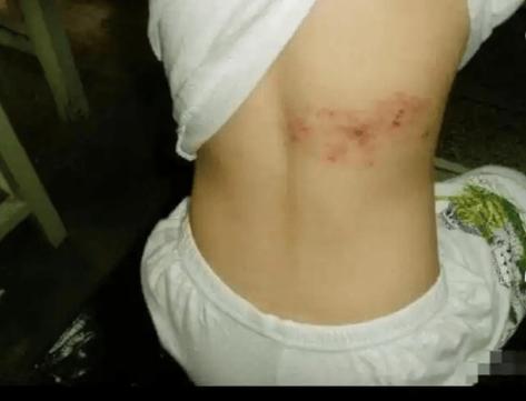 锁喉蛇症状是怎样引起的