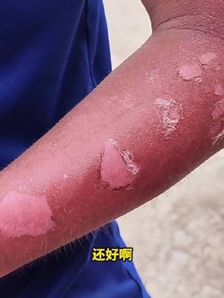 王者皮肤重复送了怎么办图标