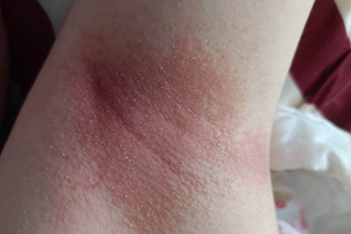 腋窝乳房下大腿根痒