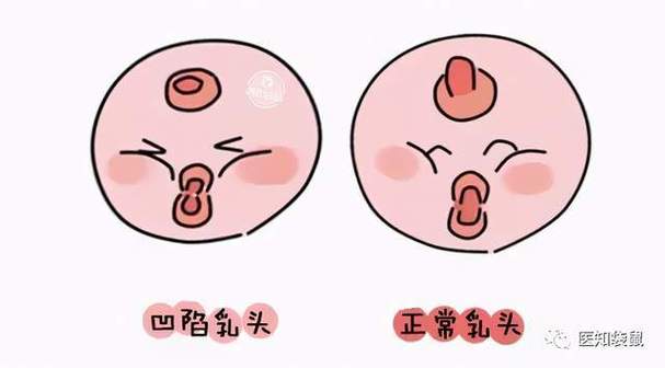 乳头臭臭的还有分泌物截图