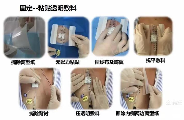 输液港维护一次费用