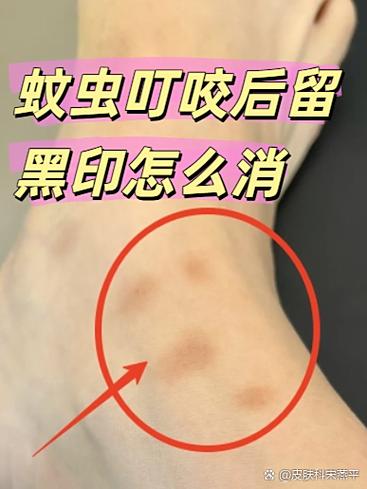 伤疤黑色素沉淀怎么去除截图