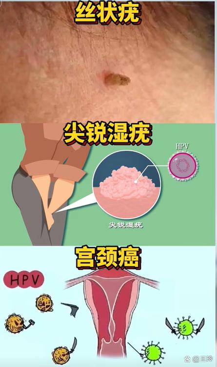 hipv病毒是什么