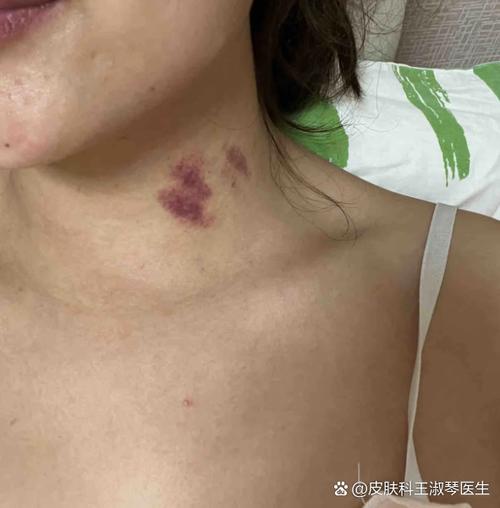 脖子无缘无故出现划痕截图