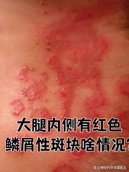 皮肤上有红色斑块不痛不痒