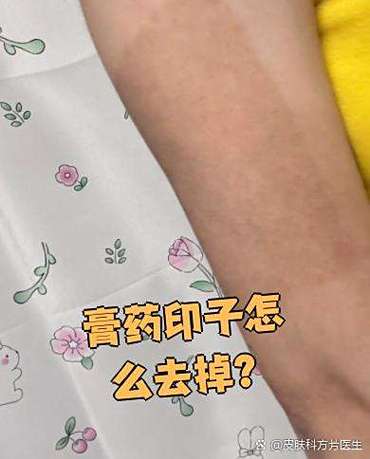 怎样去掉膏药留在身上的印
