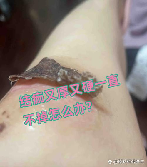 结痂又厚又硬一直不掉怎么办