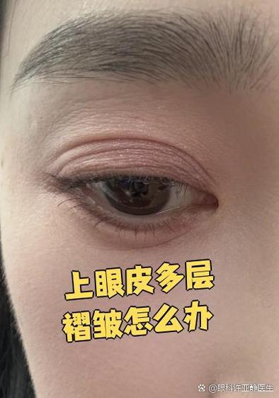 双眼皮褶皱多了好多层怎么办截图