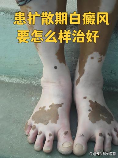 白癜风能治除根吗