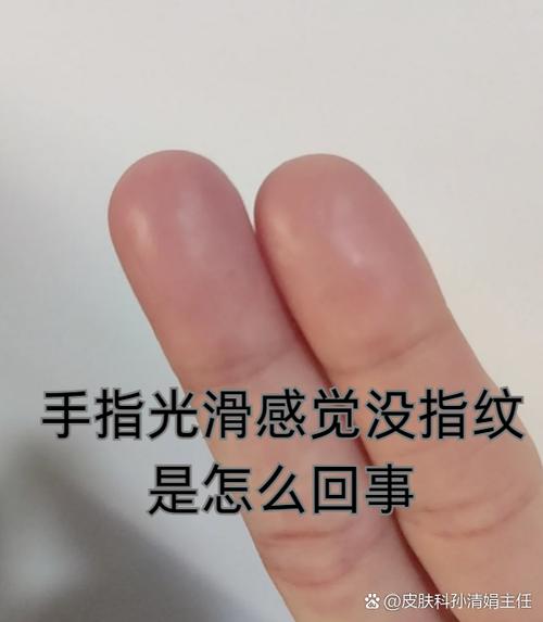 手指指纹磨没了怎么办截图