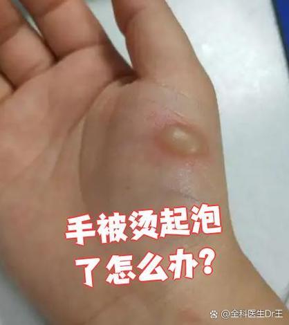 手被烫出来一个小白包该怎么办
