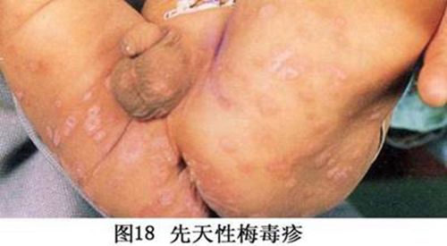 梅毒早期豆腐渣图片