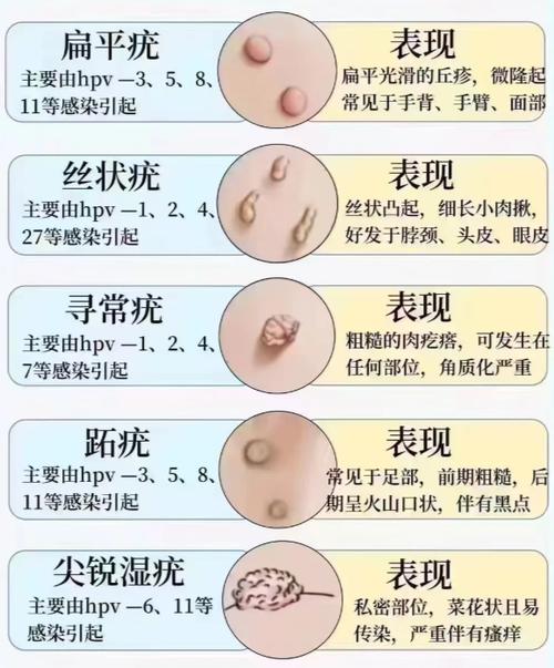 肉揪和疣的区别图片