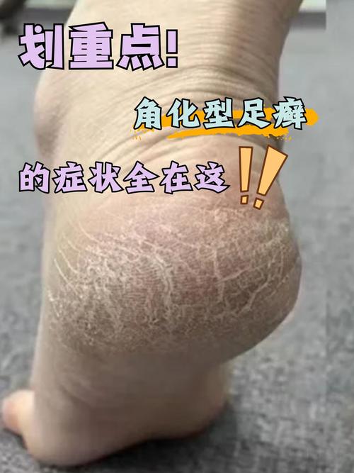 角化型脚气早期图片