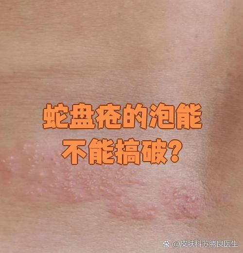 长蛇盘疱会发烧