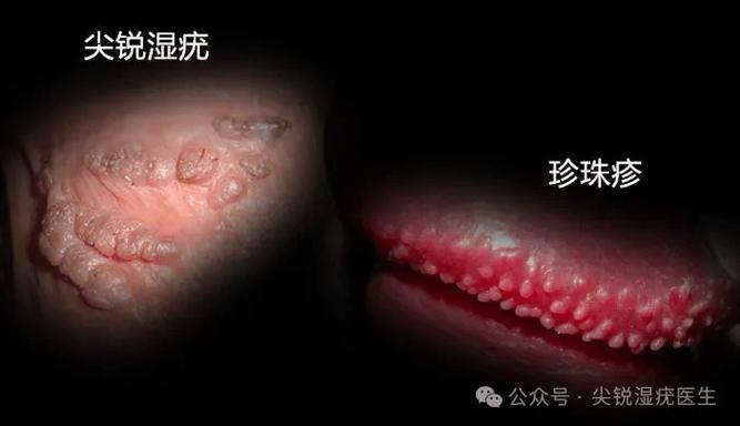 男性生殖长疣的原因是什么