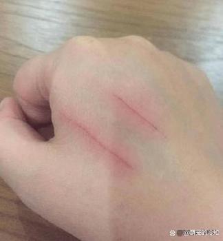 被猫抓红痕几分钟消缩略图