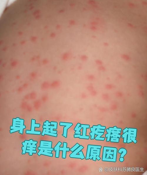 身上总是起疙瘩很痒怎么回事