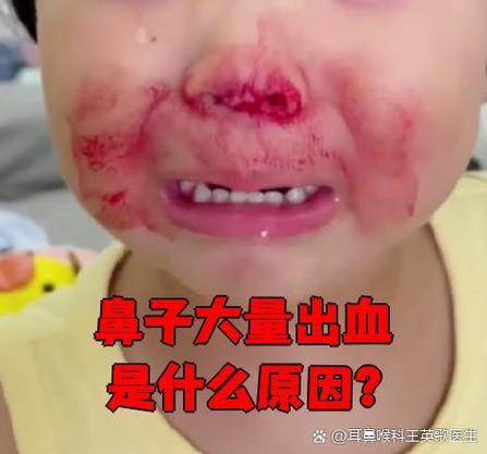 左边鼻子流鼻血
