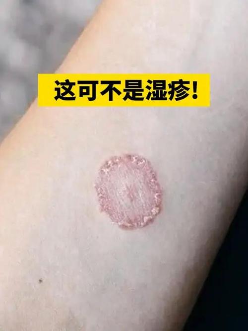 皮肤圆圈癣图片