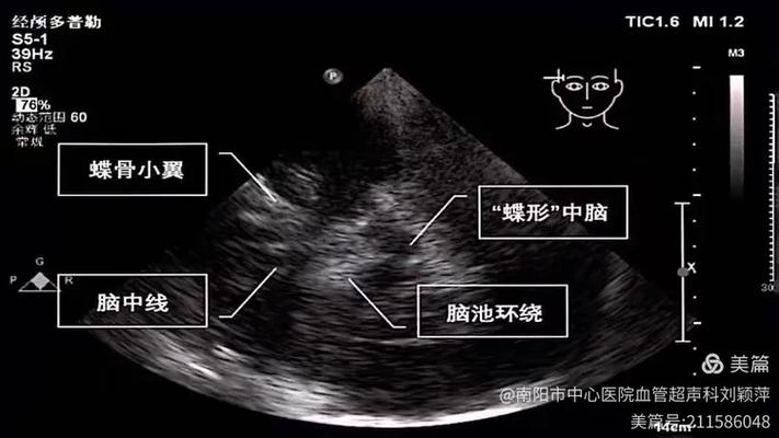黑质超声诊断标准