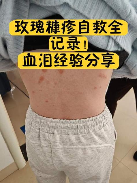 玫瑰糠疹7个阶段图片