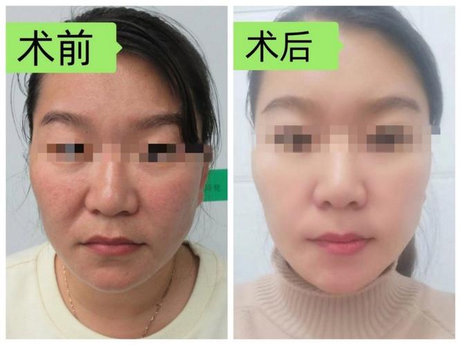 什么叫筋膜提升截图