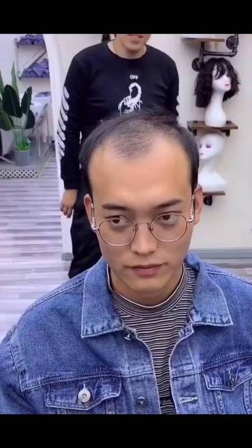 发旋脱发理什么发型截图