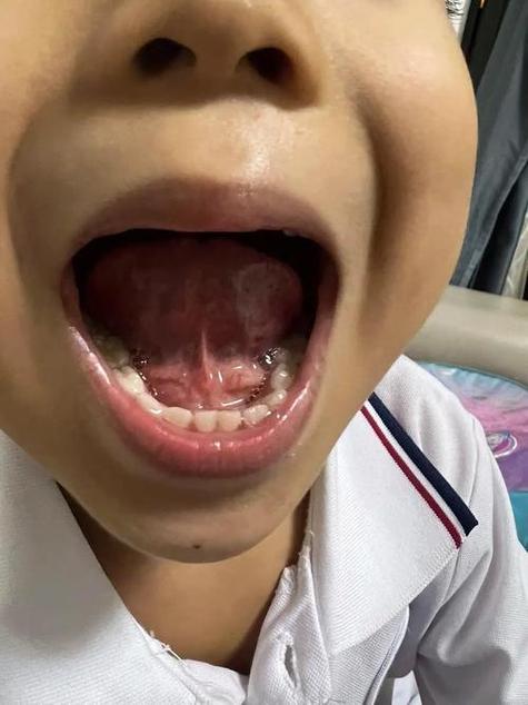 舌系带一旦割了就很难恢复吗截图