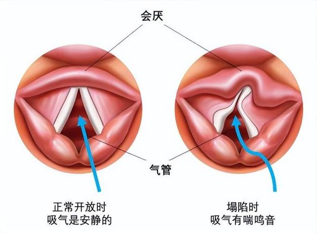 小儿喉喘鸣音在线试听截图