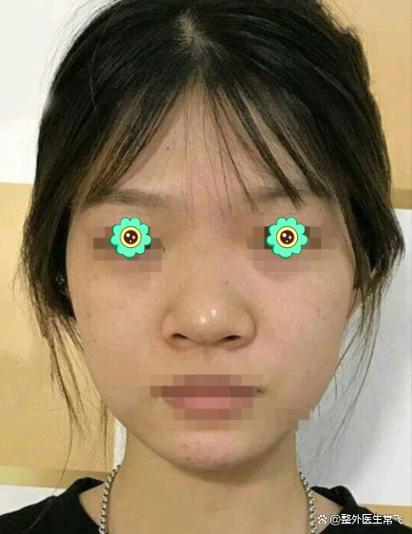 不整容怎么让鼻子变挺